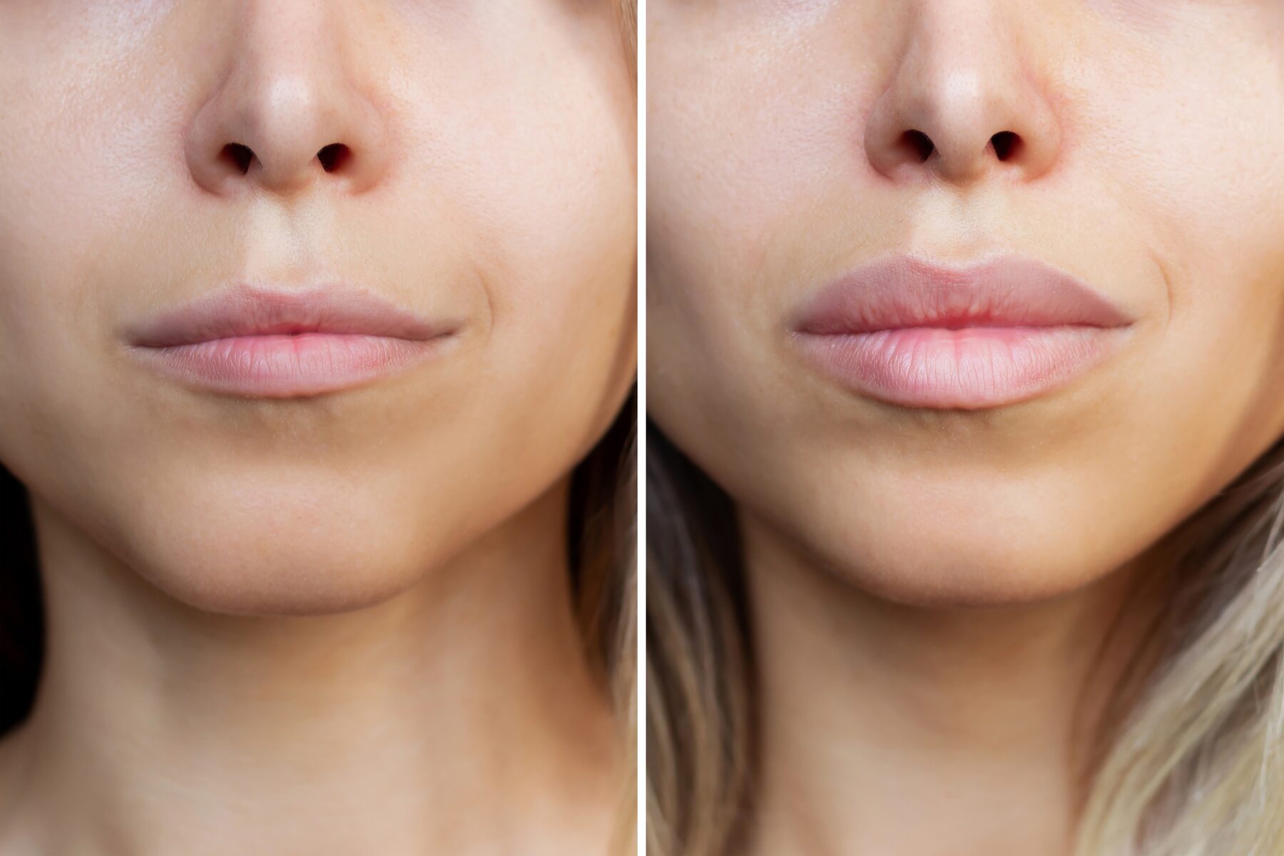 Lips before and after dermal filler treatment
