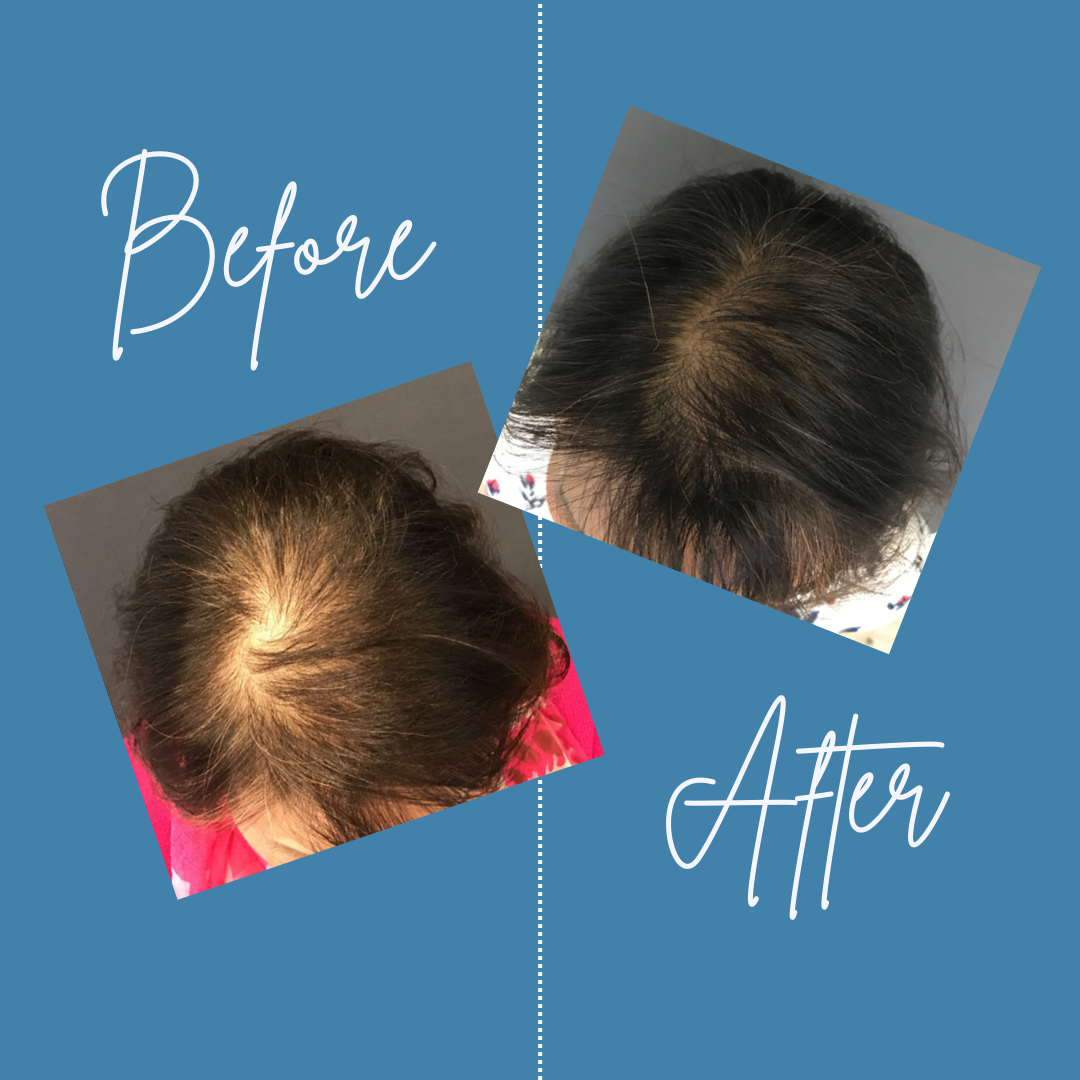 Scalp coverage before and after hair restoration treatment