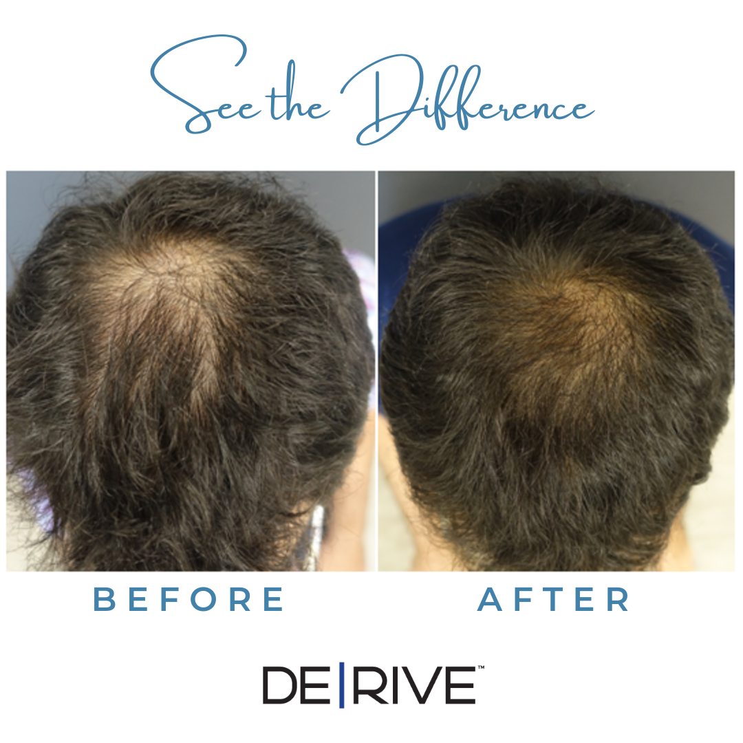 Crown thinning before and after a hair restoration course