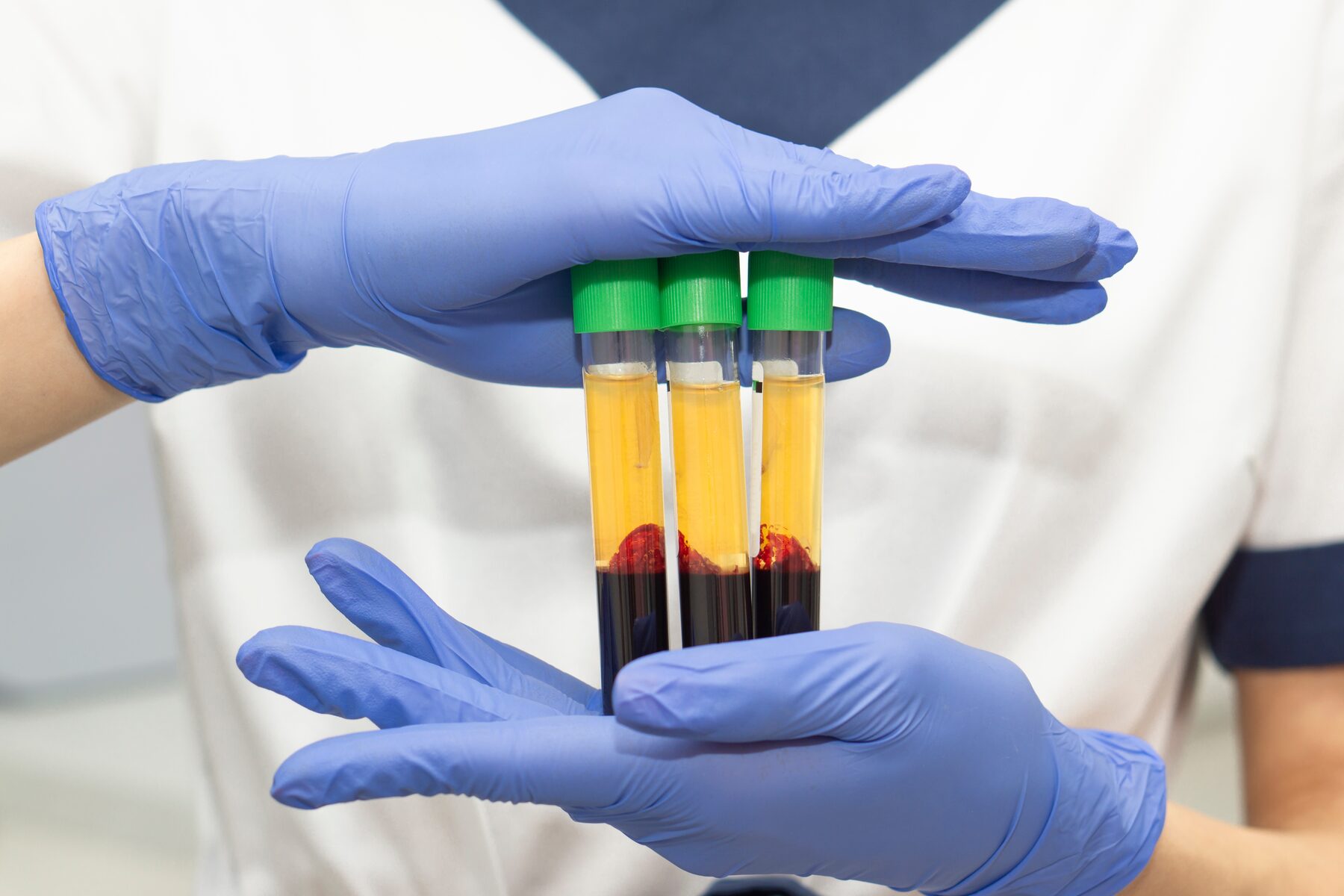 Platelet-rich plasma being prepared in a centrifuge tube in a Pulse Health & Wellness treatment room