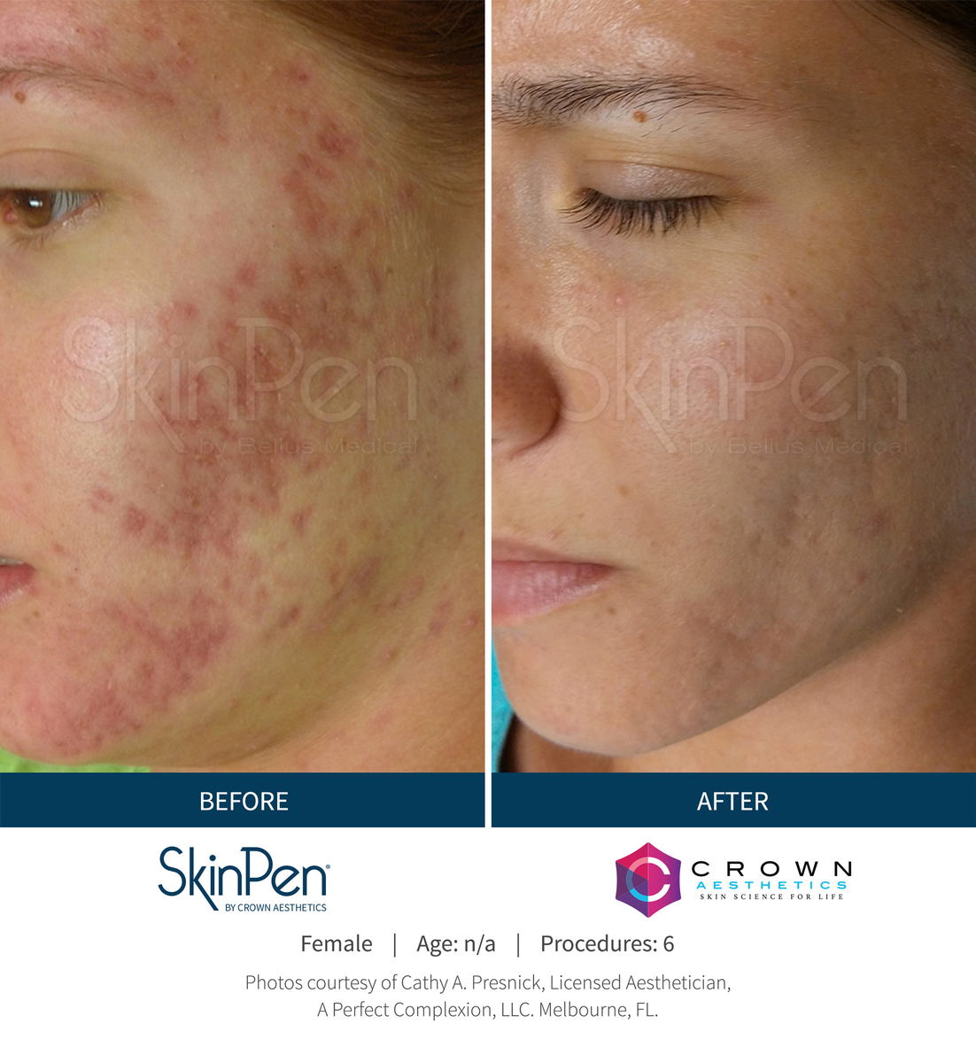 Facial texture and scarring before and after SkinPen microneedling