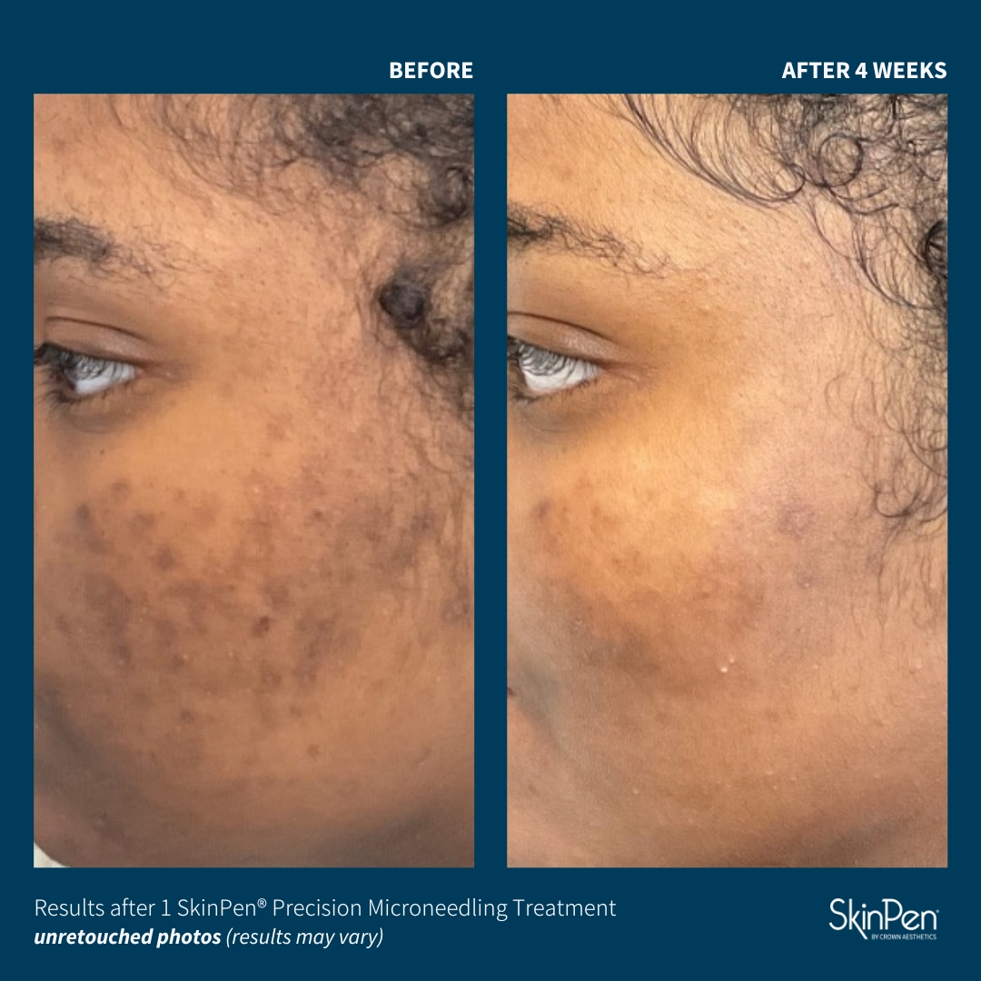 Cheek acne scarring before and after SkinPen precision microneedling